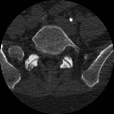 Transverse CT scan image obtained through the lowe