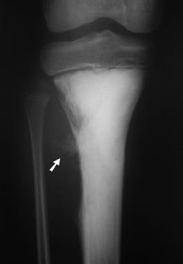 Osteosarcoma. Anteroposterior (AP) radiograph of t