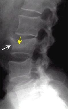 Lumbar spine trauma. Lateral radiograph demonstrat