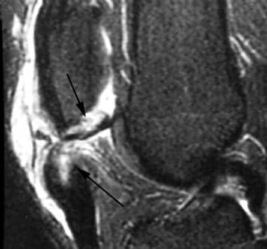 Extensor mechanism injuries of the knee. Patellar 
