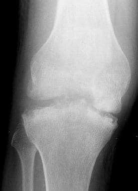 Anteroposterior radiograph from a patient with hem