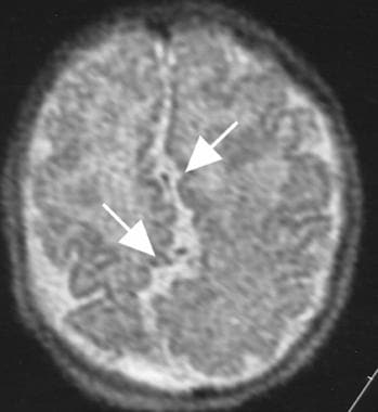 Axial T2-weighted magnetic resonance image in a pa