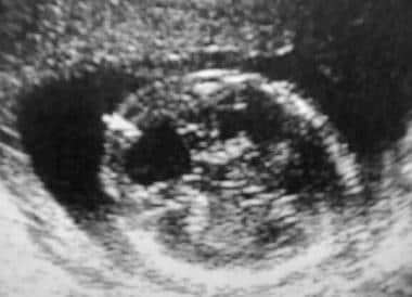 An in utero sonogram of Dandy-Walker malformation;