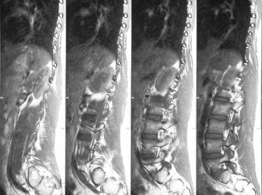 Sagittal MRIs show lumbar scoliosis. 