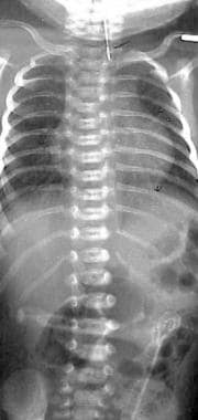 Esophageal atresia (EA) with distal tracheoesophag