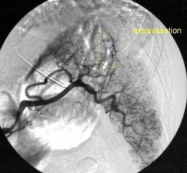 Splenic artery angiogram in a 32-year-old man who 