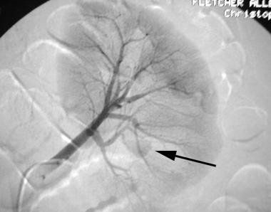 Left renal angiogram (early phase; same patient as