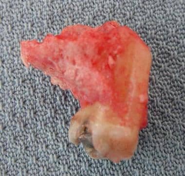 Maxillary tuberosity was adherent to extracted too