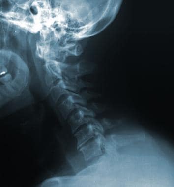Cervical spine radiograph revealing no fractures o