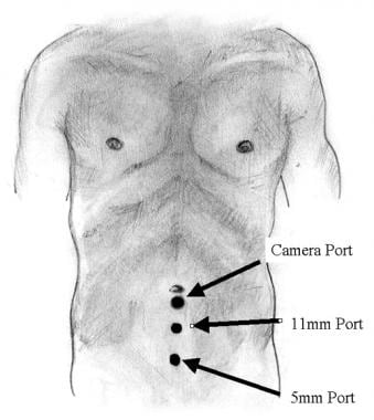 Port placement and OR setup.