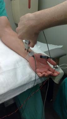 Distal median motor nerve conduction set up 