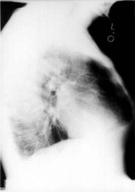 Chest radiograph of a patient with pectus carinatu