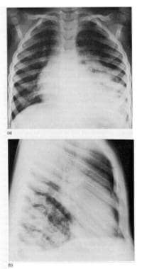 Pediatric Dilated Cardiomyopathy Workup: Approach Considerations, Blood  Studies, Chest Radiography