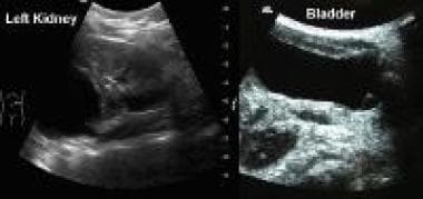 Female infant with acute pyelonephritis. The ultra