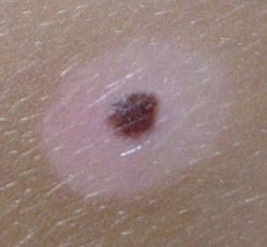 Classic appearance of a halo nevus. 
