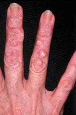 Hypertrophic lesions of chronic cutaneous lupus er