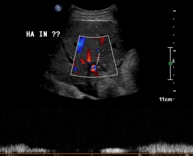 B-2: Extrahepatic artery Doppler ultrasonography s