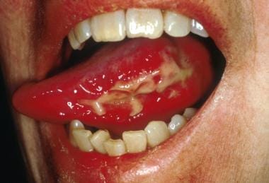 Ulcerative oral mucositis lesion on the lateral an