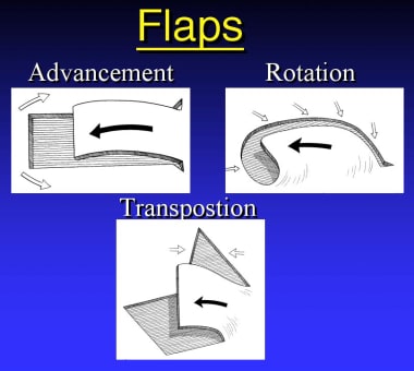 Transposition Flap