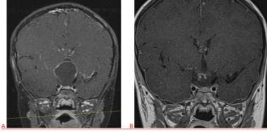 Coronal views of T1-weighted MRI for a patient wit