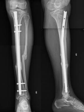 Diaphyseal tibial fracture. Six-month postoperativ