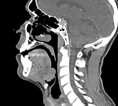A sagittal computed tomography (CT) scan of the ne