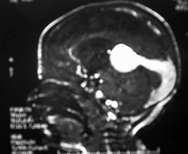 Sagittal cerebral MRI with gadolinium showing the 