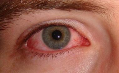 Viral conjunctivitis. Image courtesy of Wikimedia 