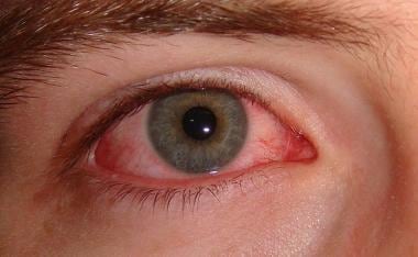 34 cases of pink eye recorded on VG