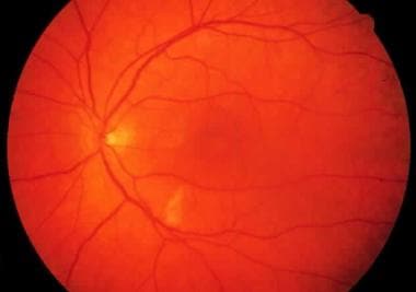 Mild Purtscher retinopathy in a patient after blun