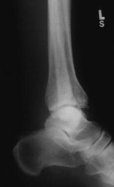 Lateral view of pilon fracture. 