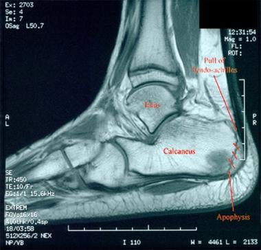 Clinical Practice Guidelines : Apophysitis of the Pelvis and Hip -  Emergency Department