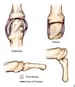 Intrinsic Plus Hand: Background, Anatomy, Pathophysiology