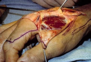 Dissection for a first dorsal metacarpal artery fl