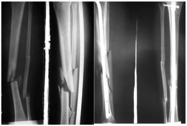 Diaphyseal tibial fracture. Unstable tibia with co