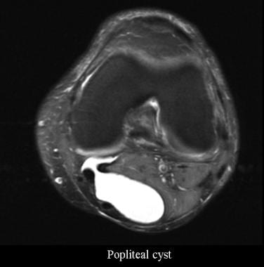 Popliteal cyst. Courtesy of James K. DeOrio, MD, L