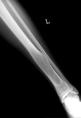Plain radiograph of a tibia in a patient who is sk