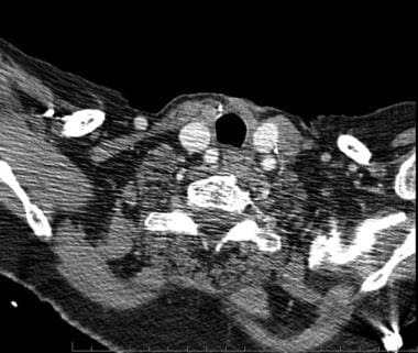 Axial CT scan of a patient one year after total th