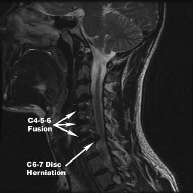 Transition level syndrome: C6-7 disc herniation de