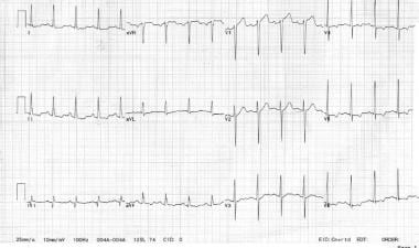 The right-sided leads indicate ST-segment elevatio