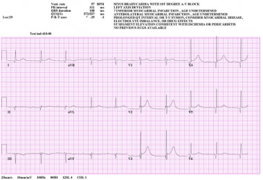 First-Degree Atrioventricular Block. 12-Lead elect