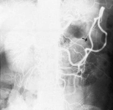 Meandering artery (radiographic sign of preexistin