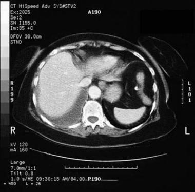 Contrast-enhanced CT scan of patient with right he