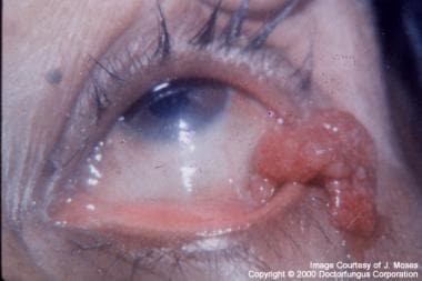 Granulomatous mass involving structures of the eye