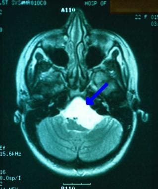 Skull base tumors. Axial T2-weighted image from an