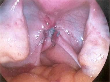 Enterocele and massive vaginal eversion. Bilateral