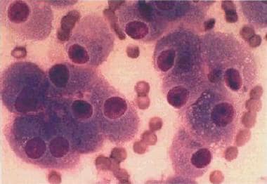 Hürthle cell carcinoma. A monomorphous cell popula