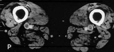Computed tomography venograms in a 65-year-old man