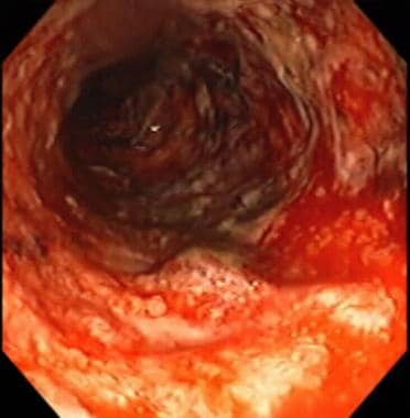 Severe colitis noted during colonoscopy. The mucos