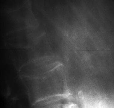 Osteoporosis of the spine. Observe the considerabl